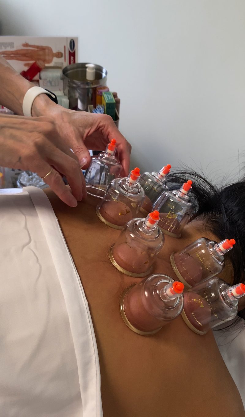 Cupping therapy at The Healing Theory